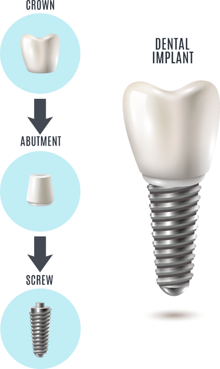 What is an implant?