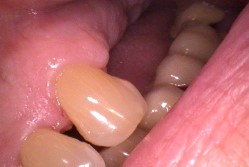 Dental Implants before