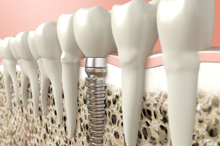 Dental Implants Santa Clarita
