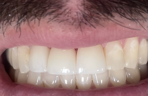 Fractured teeth crowned After