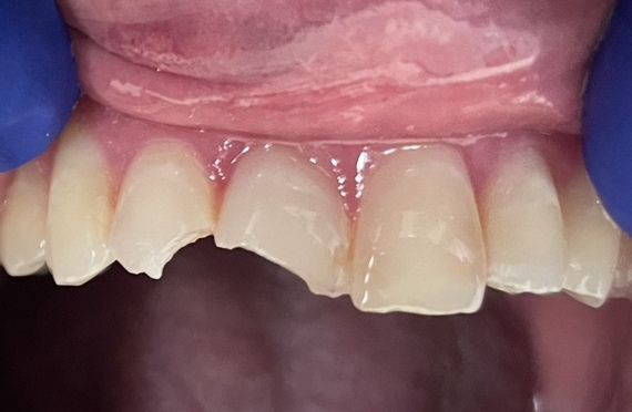 Fractured teeth crowned Before
