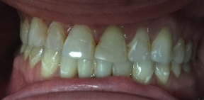 porcelain crowns before