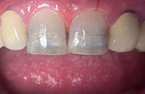 Porcelain Crowns Before