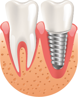 Dental Implants