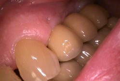 Dental Implants after