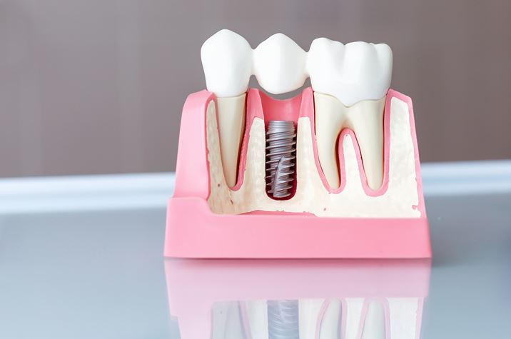 Dental Implants Santa Clarita