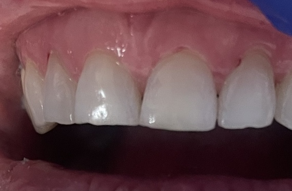 Chipped Teeth Fixed After