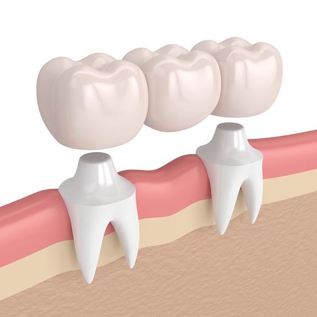 What are the benefits and types of undergoing temporary tooth bridges?